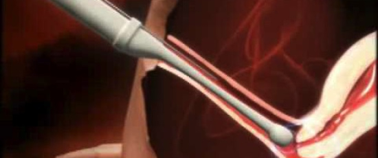 IVF - in vitro-fertilisering
