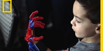 3D-printade proteser ändrar barnens liv