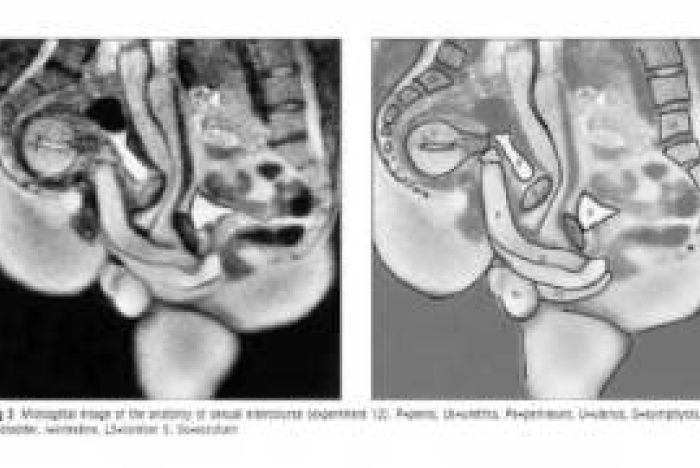 MRI-bilder av könsorganen under samlag
