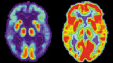 Lundaforskare ifrågasätter orsaken till Alzheimer
