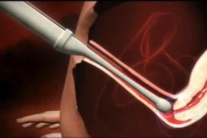 IVF - in vitro-fertilisering