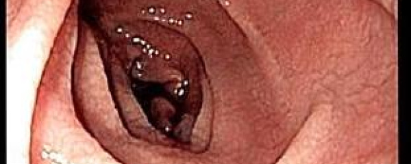 Sjukdomar i mag-/tarmkanalen