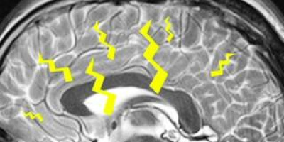 Varför drömmer man?