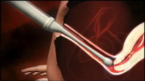 IVF - in vitro-fertilisering