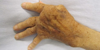 Immunologiska sjukdomar