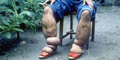 Blod, vävnadsvätska och lymfa