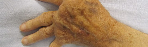 Immunologiska sjukdomar