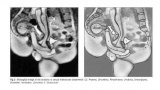 MRI-bilder av könsorganen under samlag