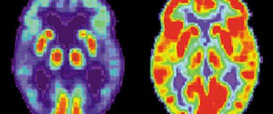 Lundaforskare ifrågasätter orsaken till Alzheimer