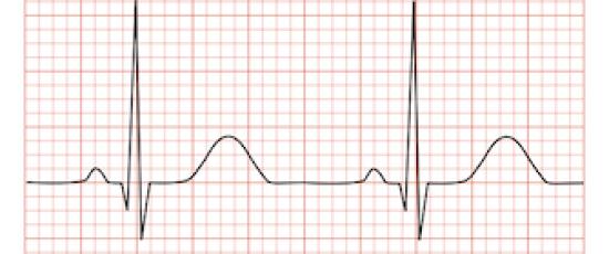 Världens första pacemaker med internetuppkoppling