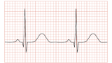 Världens första pacemaker med internetuppkoppling