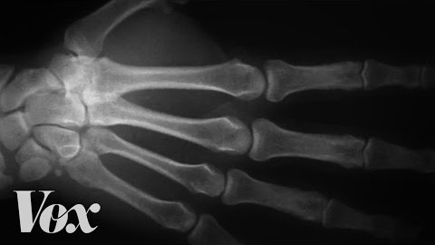 Vad händer med knogarna om du "knäcker" med dem?