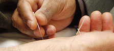 Acupuncture