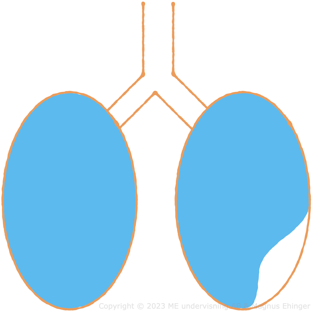 En lunga punkteras om det går hål på lungsäcken.